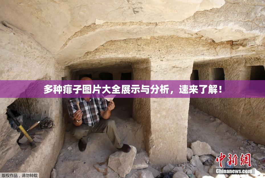 多种痱子图片大全展示与分析，速来了解！
